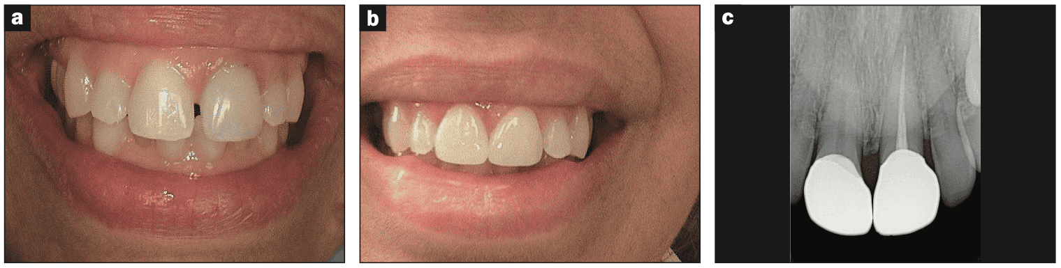 digital workflows for adult orthodontic restorative treatment