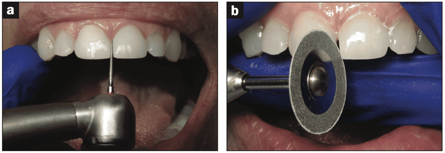 digital workflows for adult orthodontic restorative treatment