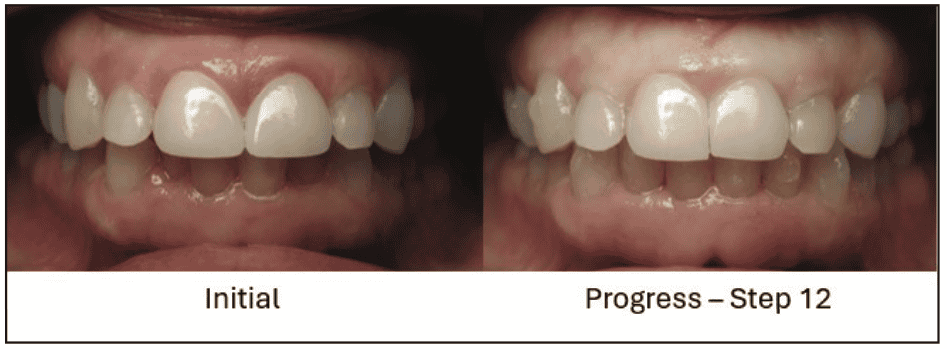 digital workflows for adult orthodontic restorative treatment